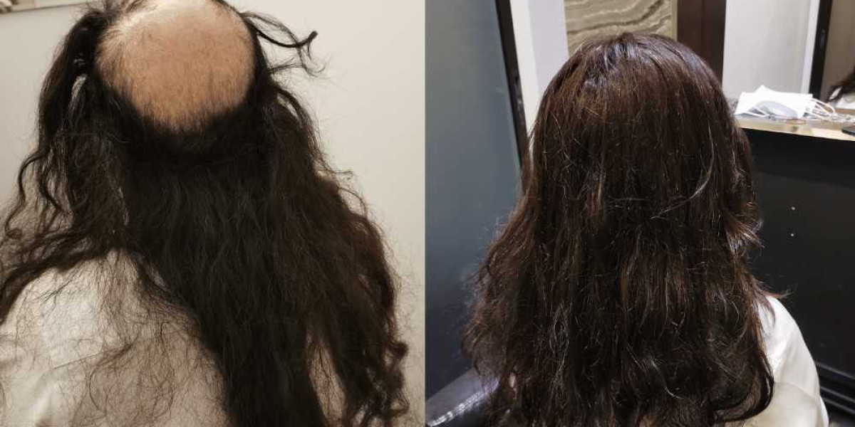 Hair Replacement SG